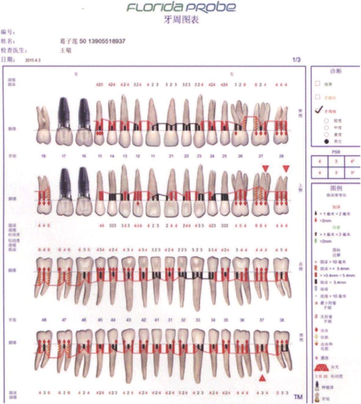 中度牙周炎并伴有種植體周圍炎患者上頜后牙區(qū)瓣轉(zhuǎn)移聯(lián)合GBR行軟硬組織增量術(shù)后種植修復(fù)治療1例